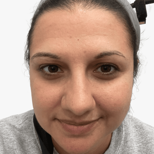 Neurotoxins Before and After - Case -1, Image 1 - Female, age 25 – 34 - Lafayette, IN - Pure Regenerative Medicine