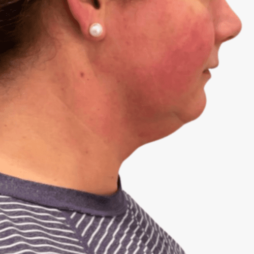 Deep RF Microneedling Before and After - Case -1, Image 1 - Female, age 35 – 44 - Lafayette, IN - Pure Regenerative Medicine