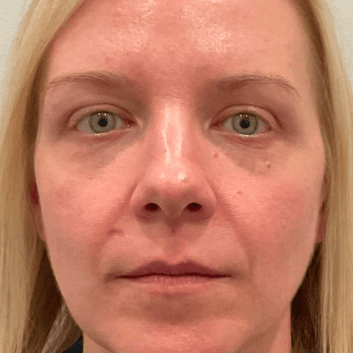 Helix Before and After - Case 10, Image 2 - Female, age 45 – 54 - Lafayette, IN - Pure Regenerative Medicine