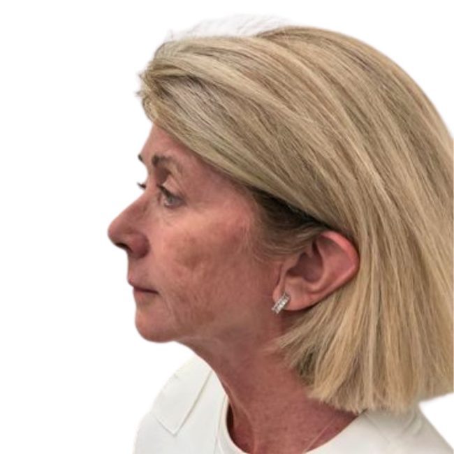 Everesse Before and After - Case 8, Image 2 - Female, age 35 – 44 - Lafayette, IN - Pure Regenerative Medicine