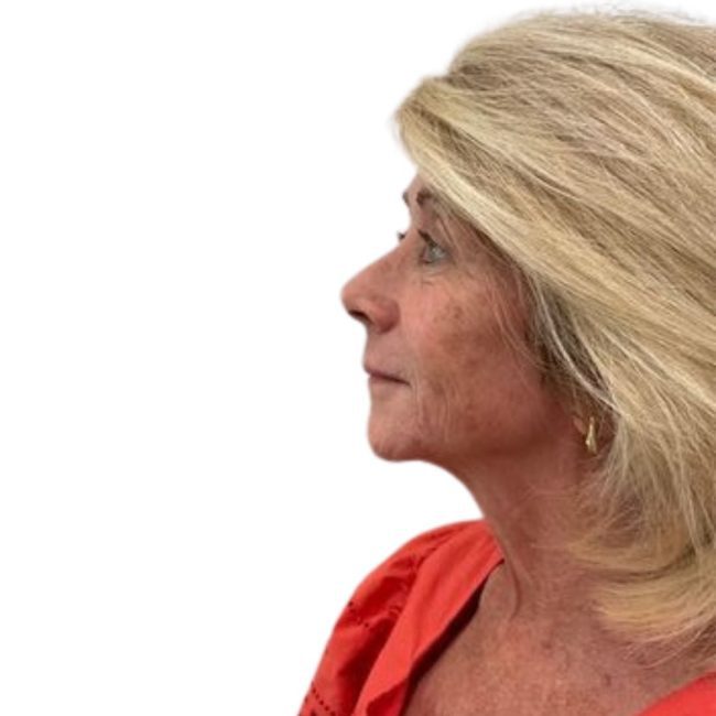Everesse Before and After - Case 8, Image 1 - Female, age 35 – 44 - Lafayette, IN - Pure Regenerative Medicine