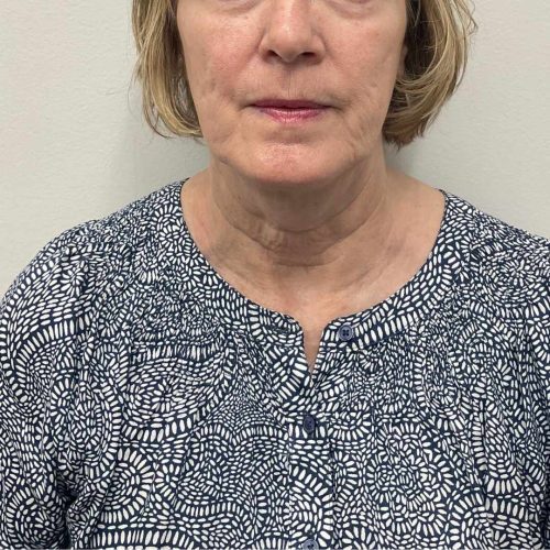 Helix Before and After - Case 13, Image 2 - Female, age 45 – 54 - Lafayette, IN - Pure Regenerative Medicine