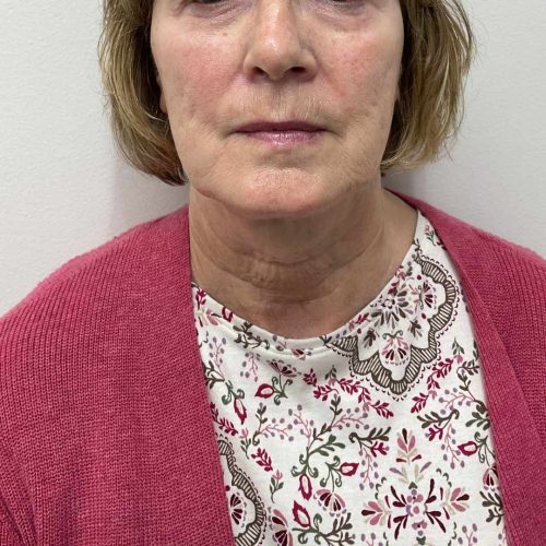 Helix Before and After - Case 13, Image 1 - Female, age 45 – 54 - Lafayette, IN - Pure Regenerative Medicine