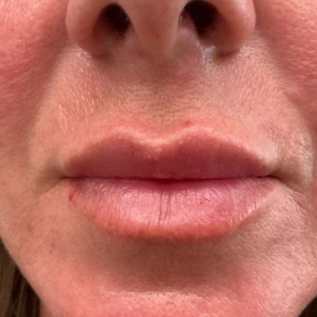 Dermal Fillers Before and After - Case 9, Image 2 - Female, age 35 – 44 - Lafayette, IN - Pure Regenerative Medicine