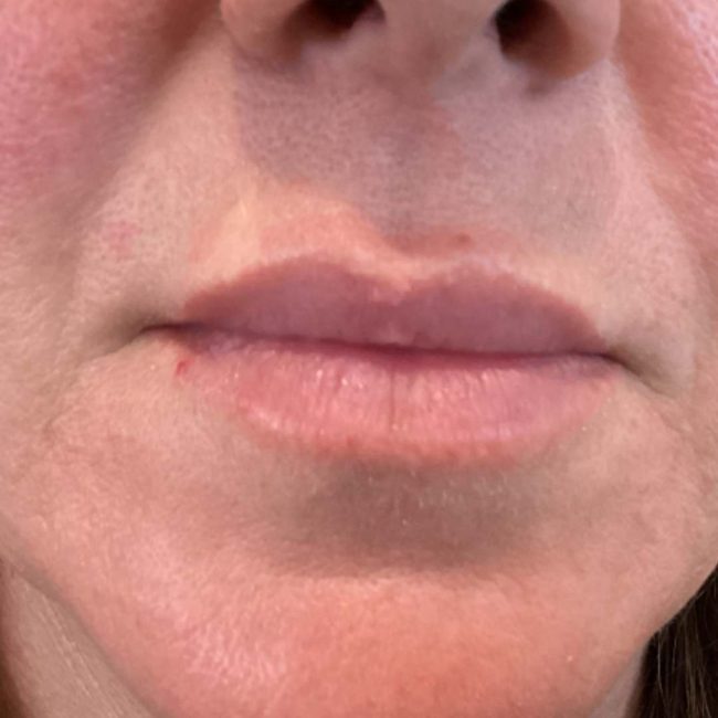 Dermal Fillers Before and After - Case 9, Image 1 - Female, age 35 – 44 - Lafayette, IN - Pure Regenerative Medicine