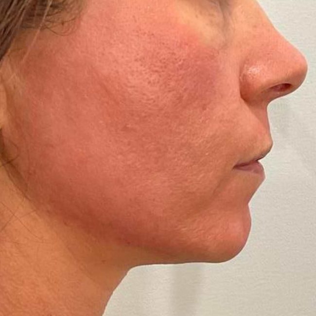 Deep RF Microneedling + CoolPeel Before and After - Case -1, Image 2 - Female, age 35 – 44 - Lafayette, IN - Pure Regenerative Medicine