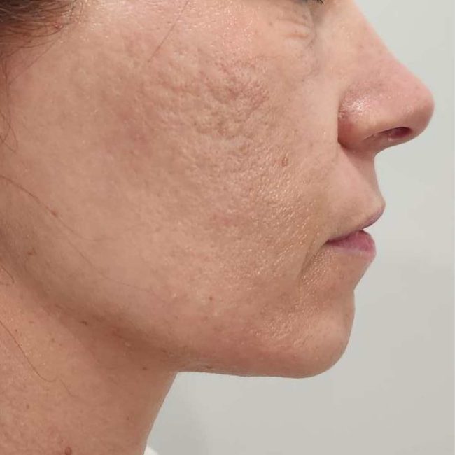 Deep RF Microneedling + CoolPeel Before and After - Case -1, Image 1 - Female, age 35 – 44 - Lafayette, IN - Pure Regenerative Medicine