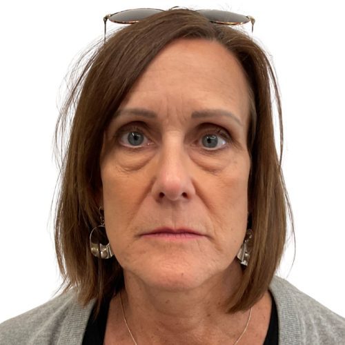 Helix Before and After - Case 12, Image 1 - Female, age 45 – 54 - Lafayette, IN - Pure Regenerative Medicine