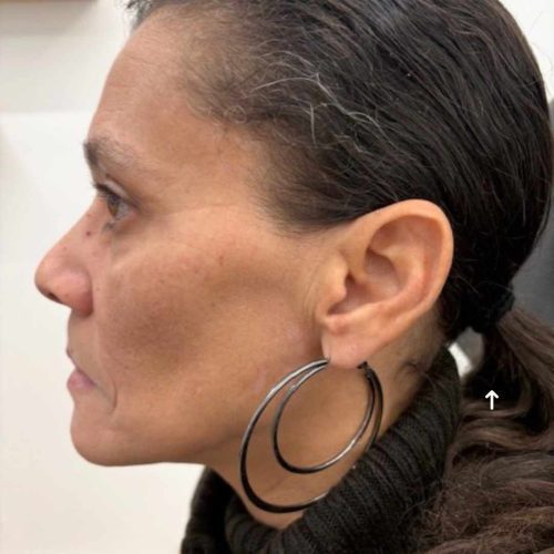 Helix Before and After - Case 15, Image 2 - Female, age 45 – 54 - Lafayette, IN - Pure Regenerative Medicine