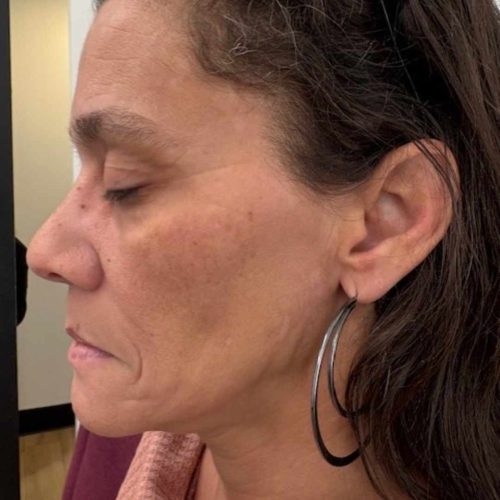 Helix Before and After - Case 15, Image 1 - Female, age 45 – 54 - Lafayette, IN - Pure Regenerative Medicine