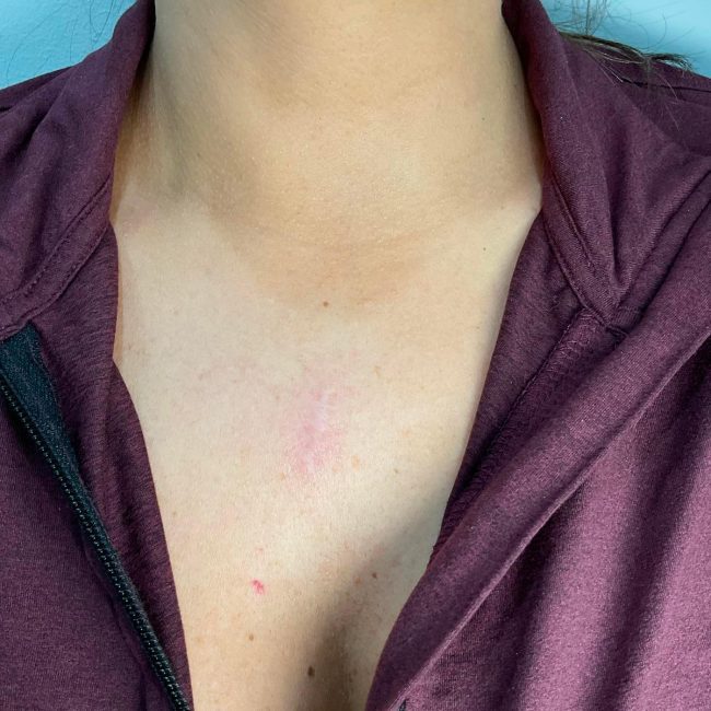 Deka for Scars Before and After - Case -1, Image 2 - Female, age  - Lafayette, IN - Pure Regenerative Medicine