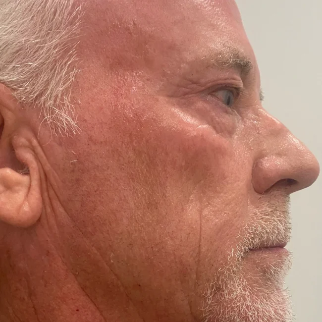 Deep RF Microneedling Before and After - Case 3, Image 2 - Male, age 45 – 54 - Lafayette, IN - Pure Regenerative Medicine