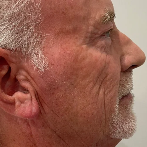 Deep RF Microneedling Before and After - Case 3, Image 1 - Male, age 45 – 54 - Lafayette, IN - Pure Regenerative Medicine