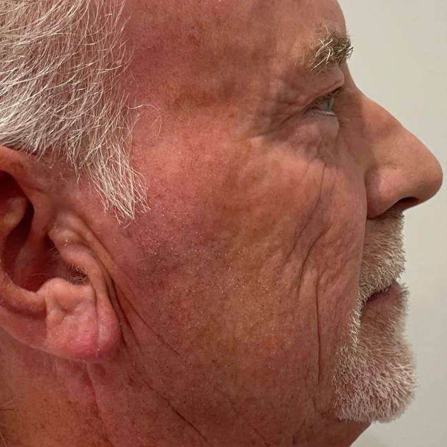 Deep RF Microneedling Before and After - Case 3, Image 1 - Male, age 45 – 54 - Lafayette, IN - Pure Regenerative Medicine