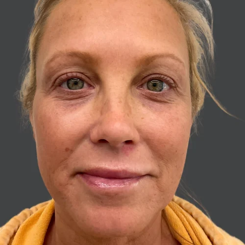 Helix Before and After - Case 19, Image 2 - Female, age 45 – 54 - Lafayette, IN - Pure Regenerative Medicine