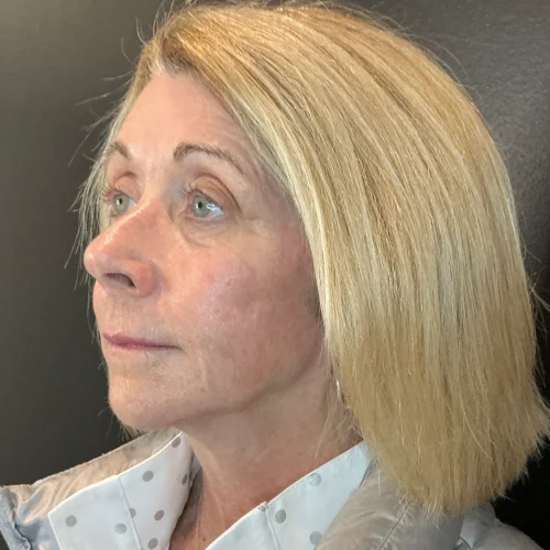 Helix Before and After - Case 17, Image 2 - Female, age 55 – 64 - Lafayette, IN - Pure Regenerative Medicine