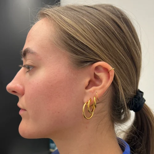 Helix Before and After - Case 18, Image 2 - Female, age 25 – 34 - Lafayette, IN - Pure Regenerative Medicine