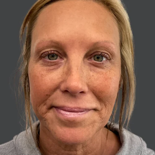 Helix Before and After - Case 19, Image 1 - Female, age 45 – 54 - Lafayette, IN - Pure Regenerative Medicine