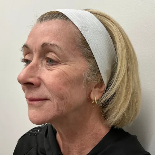 Helix Before and After - Case 17, Image 1 - Female, age 55 – 64 - Lafayette, IN - Pure Regenerative Medicine