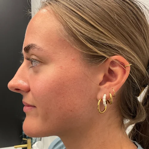 Helix Before and After - Case 18, Image 1 - Female, age 25 – 34 - Lafayette, IN - Pure Regenerative Medicine