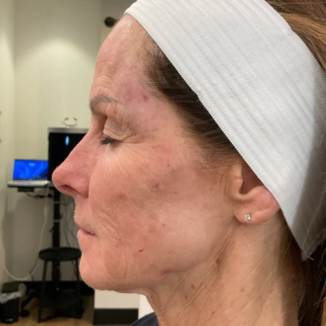 Radiesse Before and After - Case -1, Image 2 - Female, age 65+ - Lafayette, IN - Pure Regenerative Medicine