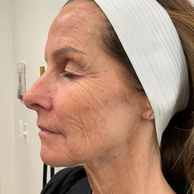 Radiesse Before and After - Case -1, Image 1 - Female, age 65+ - Lafayette, IN - Pure Regenerative Medicine