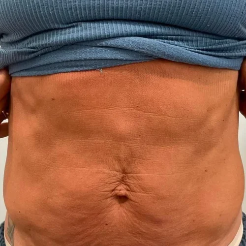Deep RF Microneedling + CoolPeel Before and After - Case 2, Image 2 - Female, age 35 – 44 - Lafayette, IN - Pure Regenerative Medicine