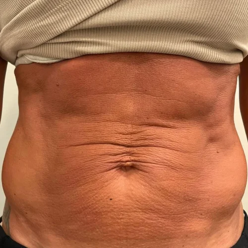 Deep RF Microneedling + CoolPeel Before and After - Case 2, Image 1 - Female, age 35 – 44 - Lafayette, IN - Pure Regenerative Medicine