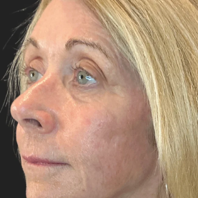 Moveo PL + Helix Before and After - Case 1, Image 2 - Female, age 55 – 64 - Lafayette, IN - Pure Regenerative Medicine