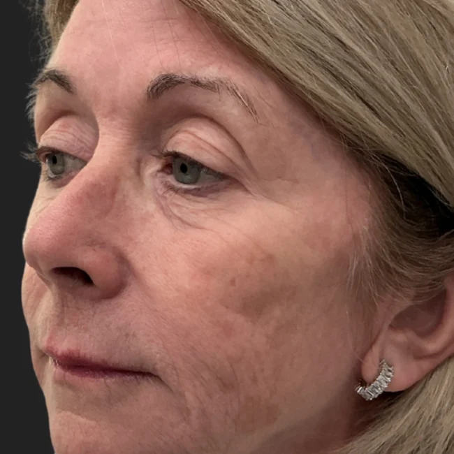 Moveo PL + Helix Before and After - Case 1, Image 1 - Female, age 55 – 64 - Lafayette, IN - Pure Regenerative Medicine